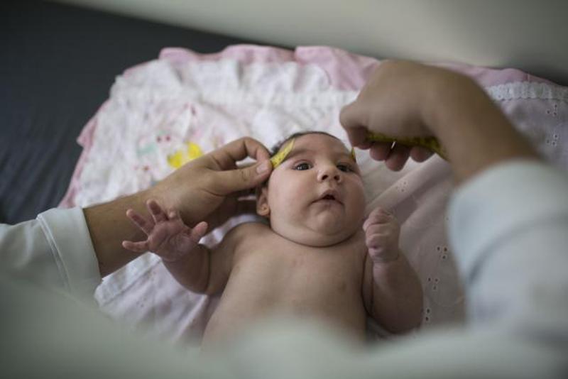 ZIKA MIKROKEFALIA