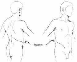 4214211223709209 Image No 1 Open Kidney Surgery